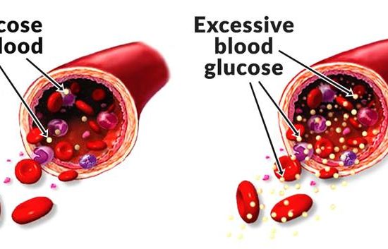 Diabetes & Blood Sugar » How To Relief